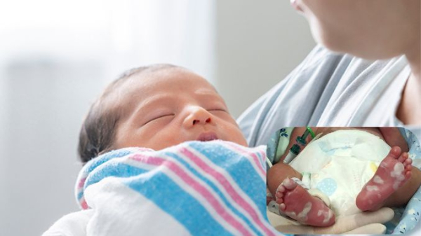 U.S. Syphilis Cases in Newborns Continue to Increase: A 10-Times Increase Over a Decade